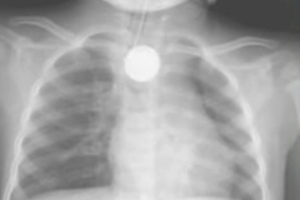X-Ray of battery in Red Deer toddler